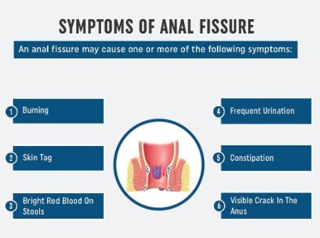 anal-fissures-image